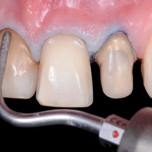 ANTERIOR INDIRECT MASTERCLASS (11th - 12th June 2027)