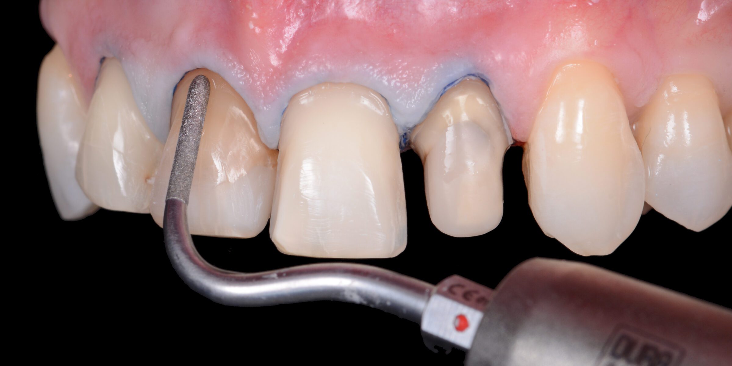 1.Anterior Indirect