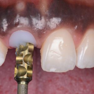 LIVE IMPLANTOLOGY WORKSHOP (20th June 2026)